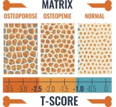 osteoporose-616x569.png