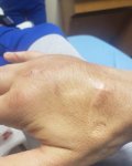 Malignaggis rechte Hand.jpg